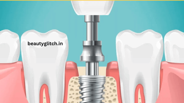 How Can I Get the Best Results from Implant Surgery?